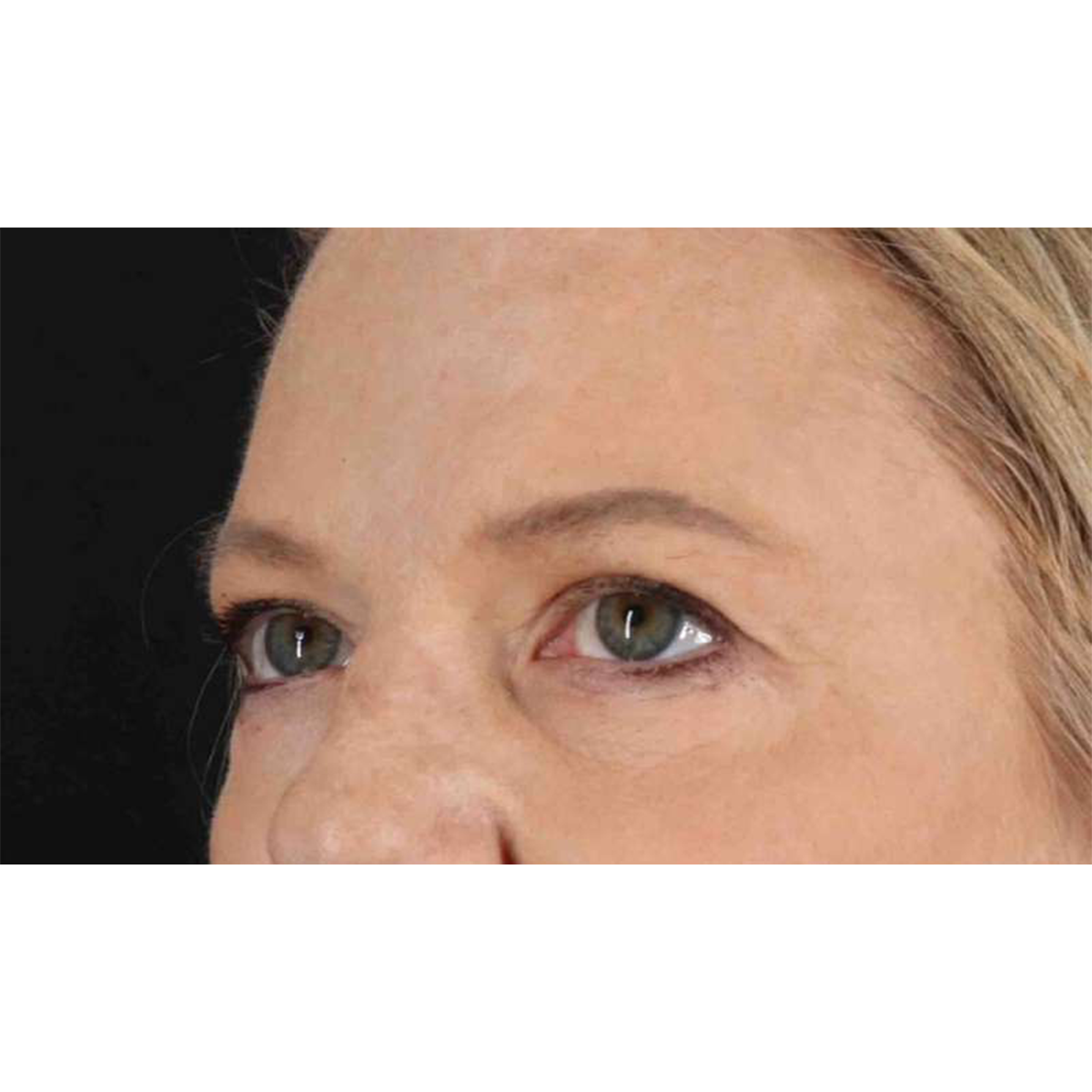 Blepharoplasty (Eyelid Surgery) Before & After Patient #10738