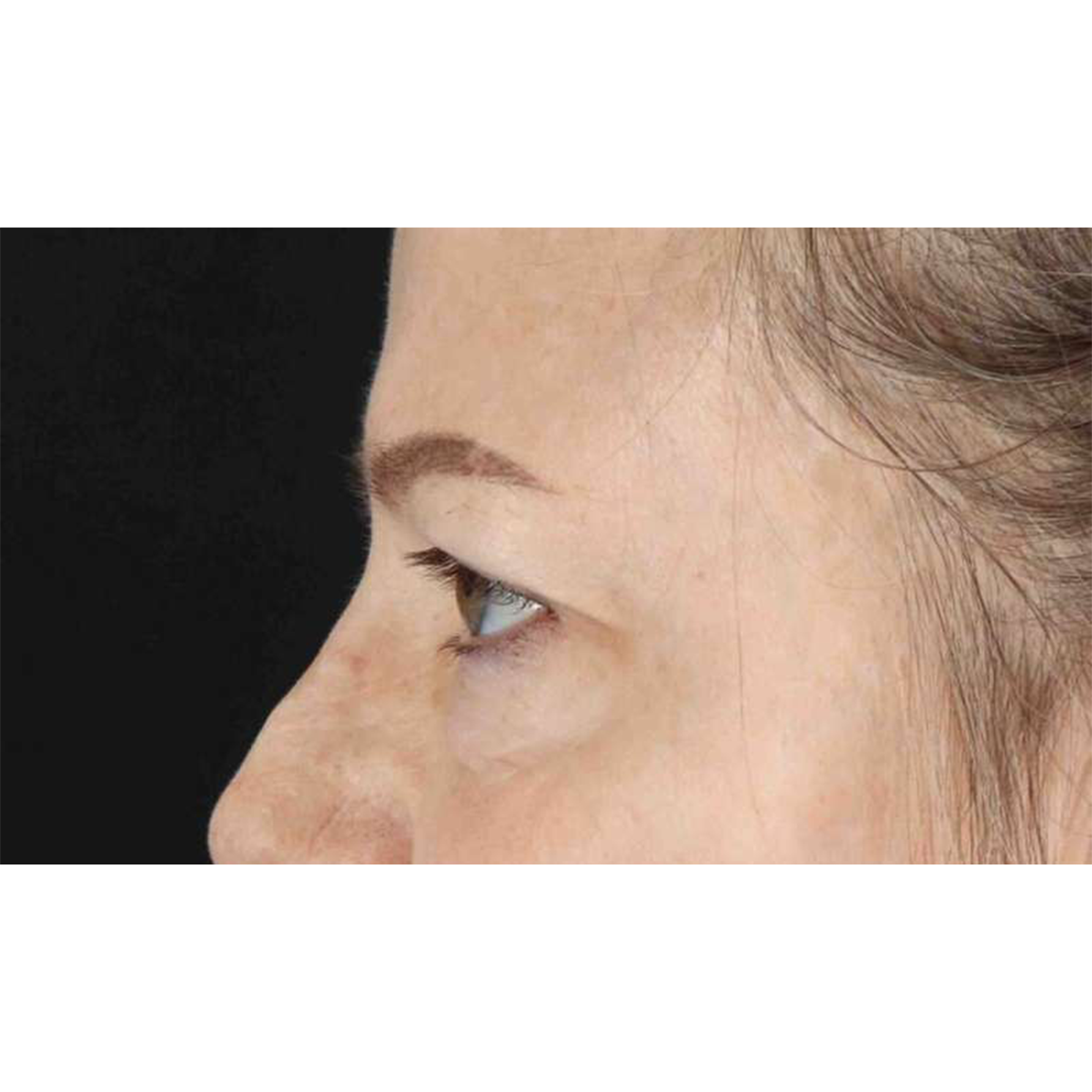 Blepharoplasty (Eyelid Surgery) Before & After Patient #10738