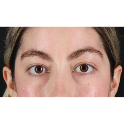 Blepharoplasty (Eyelid Surgery) Before & After Patient #10727