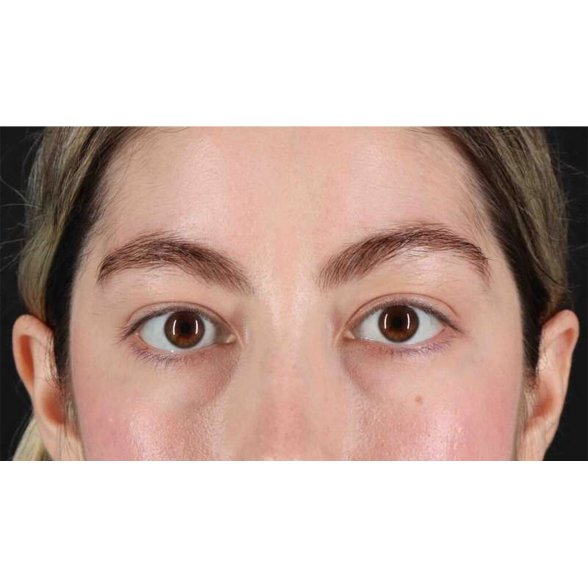 Blepharoplasty (Eyelid Surgery) Before & After Patient #10727