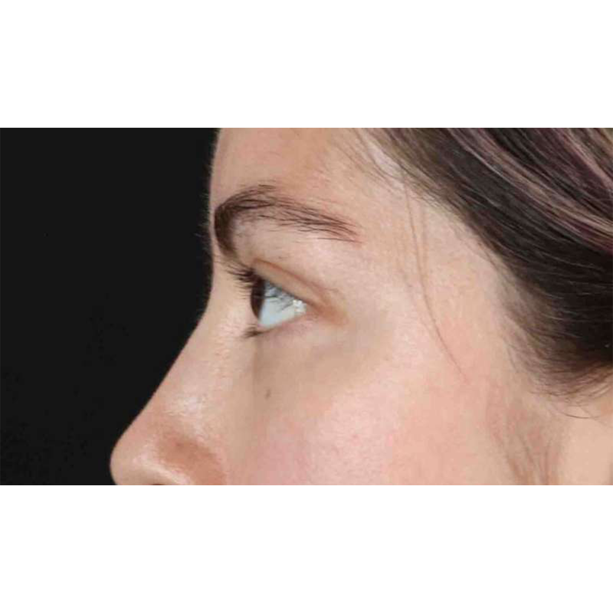 Blepharoplasty (Eyelid Surgery) Before & After Patient #10727