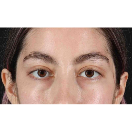 Blepharoplasty (Eyelid Surgery) Before & After Patient #10727