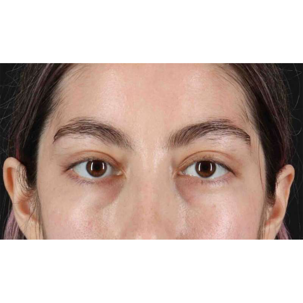 Blepharoplasty (Eyelid Surgery) Before & After Patient #10727
