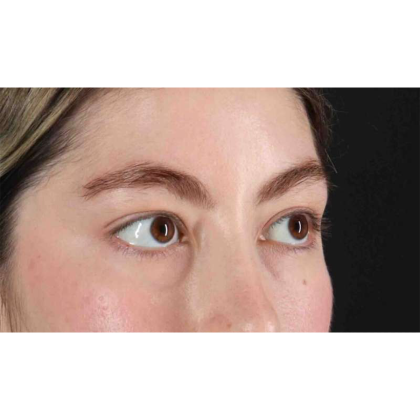 Blepharoplasty (Eyelid Surgery) Before & After Patient #10727