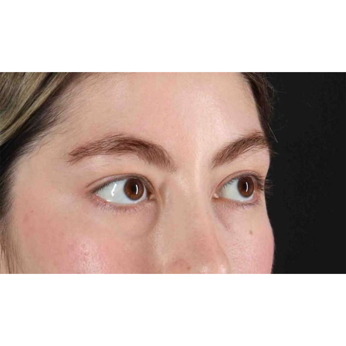 Blepharoplasty (Eyelid Surgery) Before & After Patient #10727