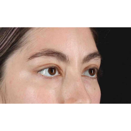 Blepharoplasty (Eyelid Surgery) Before & After Patient #10727
