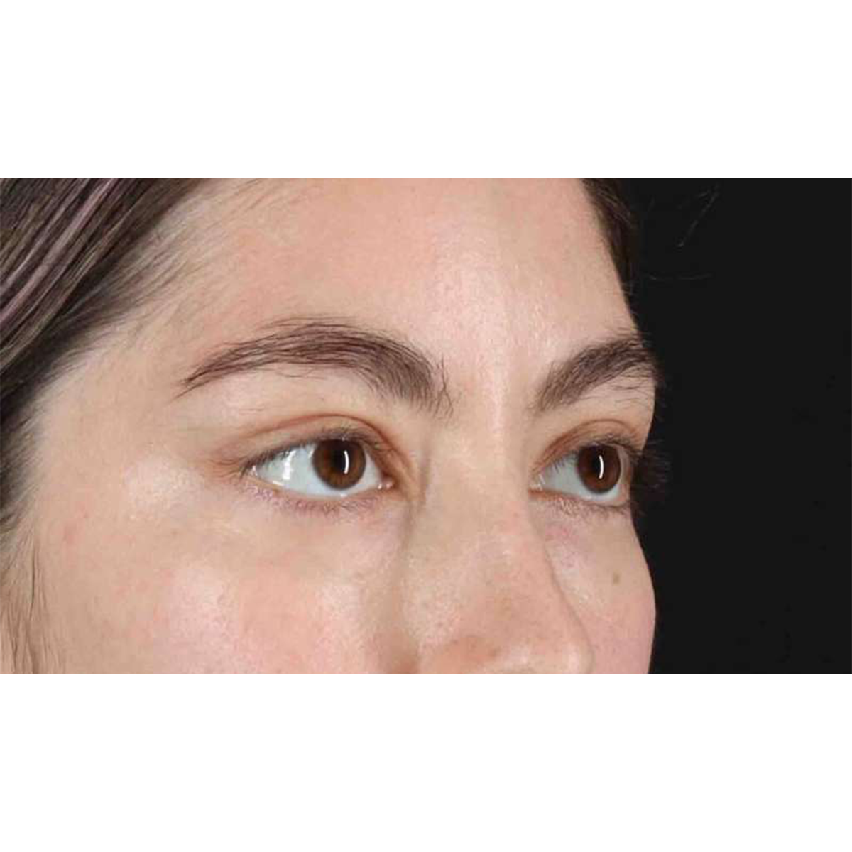 Blepharoplasty (Eyelid Surgery) Before & After Patient #10727