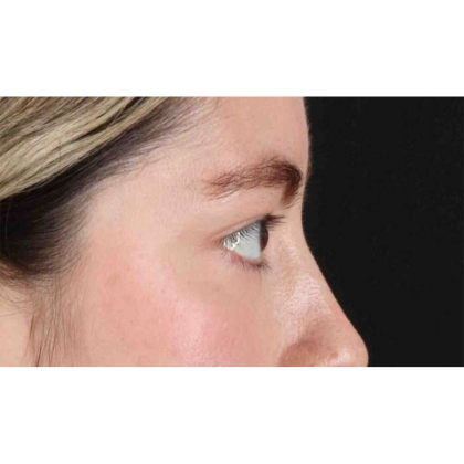 Blepharoplasty (Eyelid Surgery) Before & After Patient #10727