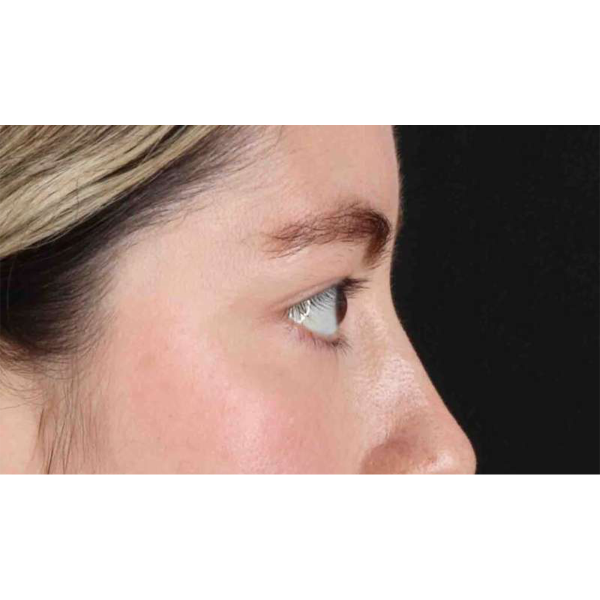 Blepharoplasty (Eyelid Surgery) Before & After Patient #10727