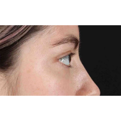 Blepharoplasty (Eyelid Surgery) Before & After Patient #10727