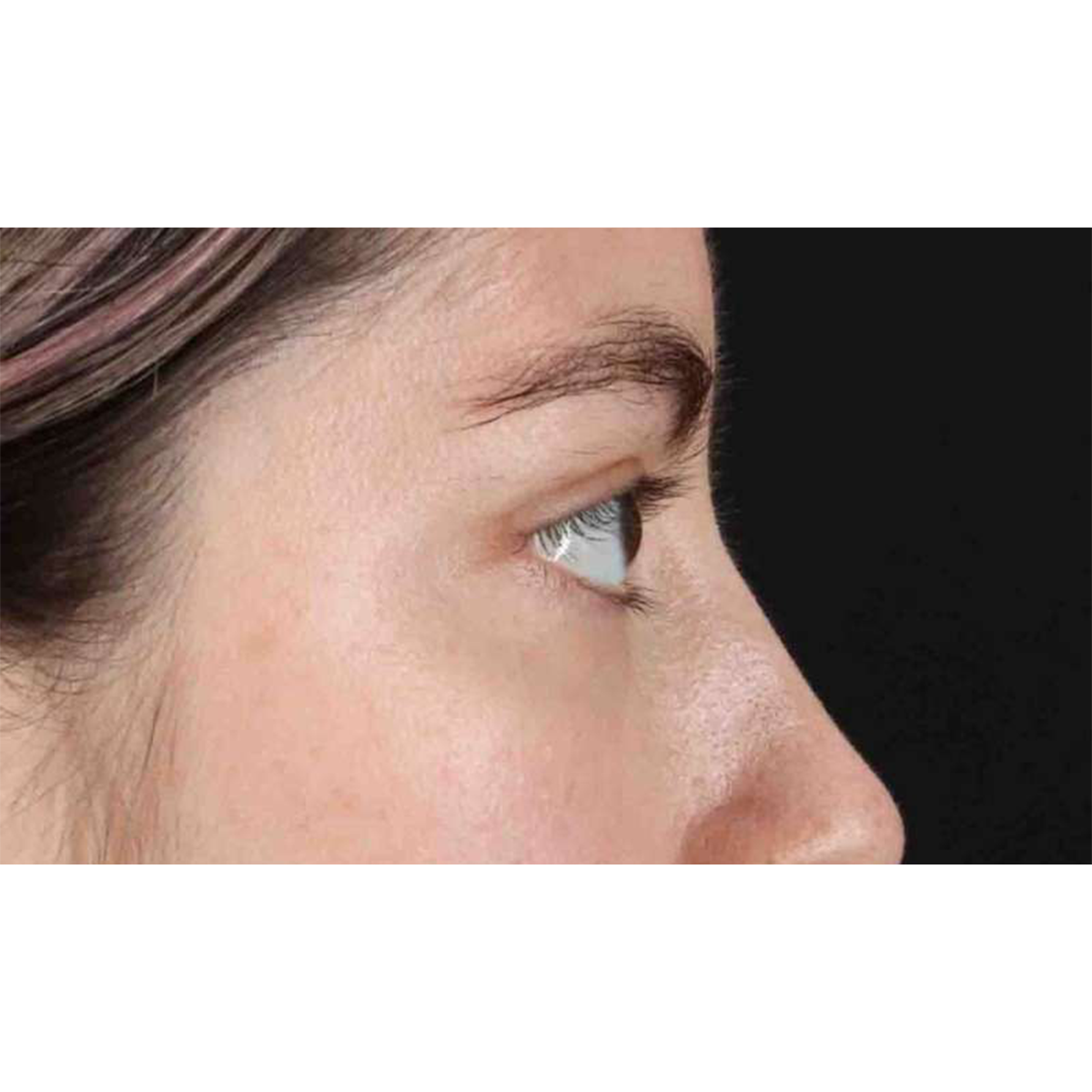 Blepharoplasty (Eyelid Surgery) Before & After Patient #10727