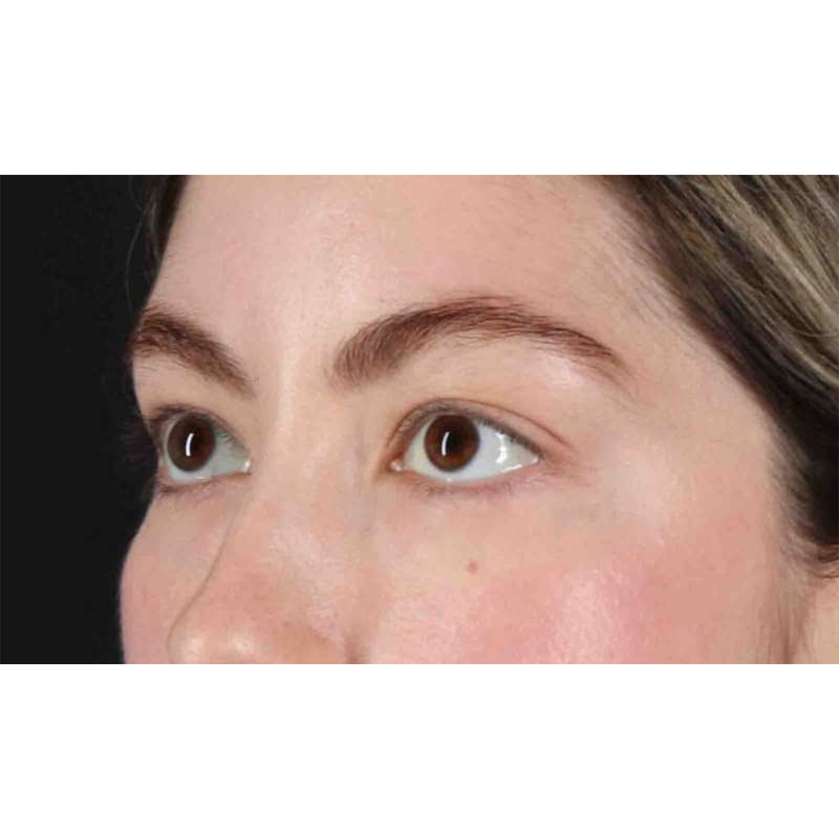 Blepharoplasty (Eyelid Surgery) Before & After Patient #10727
