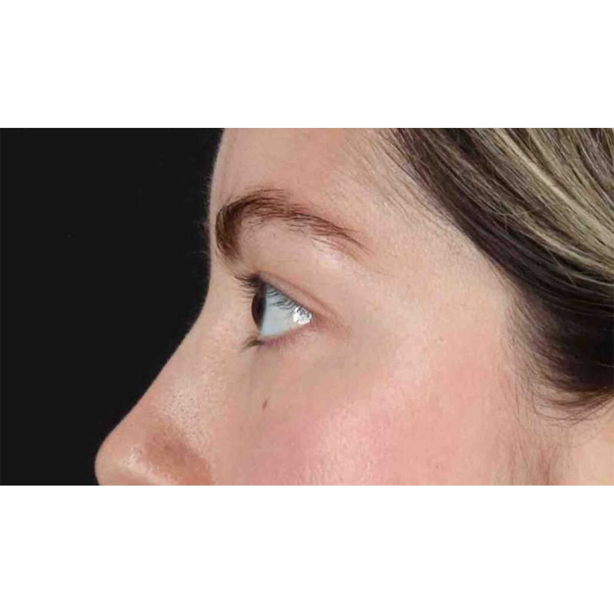 Blepharoplasty (Eyelid Surgery) Before & After Patient #10727
