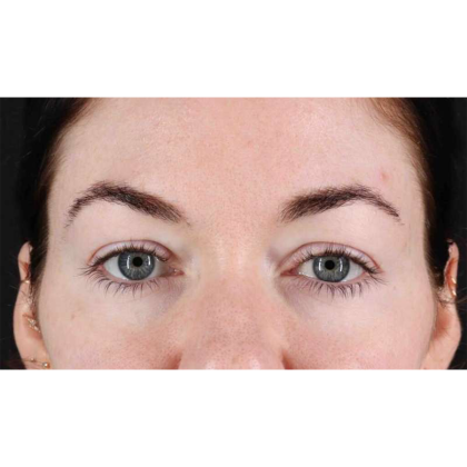 Blepharoplasty (Eyelid Surgery) Before & After Patient #10716