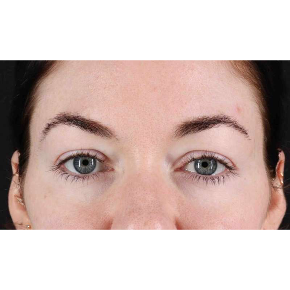 Blepharoplasty (Eyelid Surgery) Before & After Patient #10716