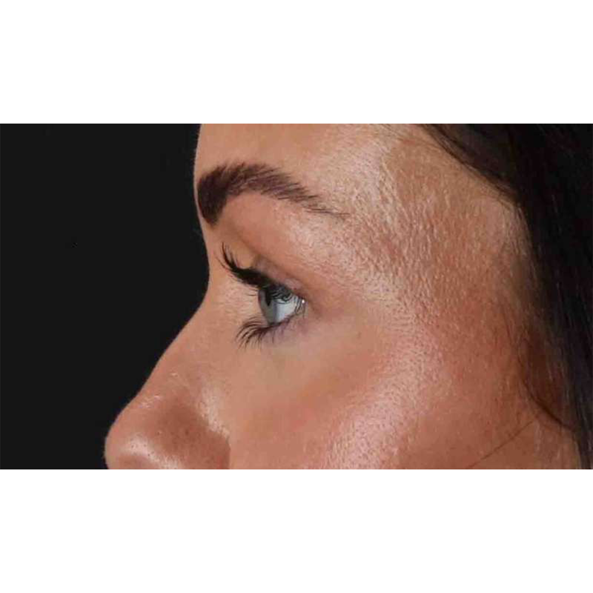 Blepharoplasty (Eyelid Surgery) Before & After Patient #10716