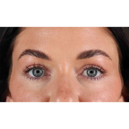 Blepharoplasty (Eyelid Surgery) Before & After Patient #10716