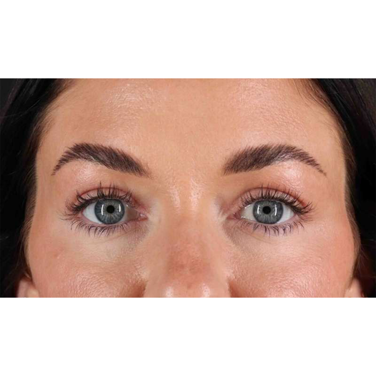 Blepharoplasty (Eyelid Surgery) Before & After Patient #10716