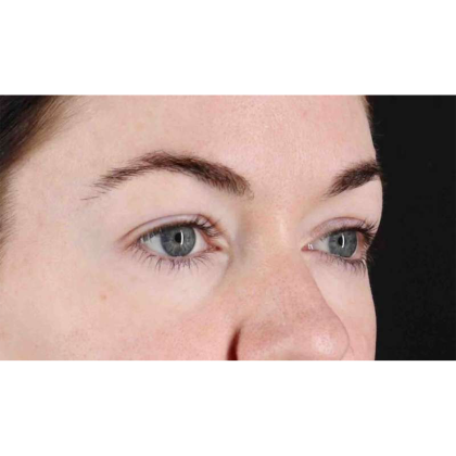 Blepharoplasty (Eyelid Surgery) Before & After Patient #10716