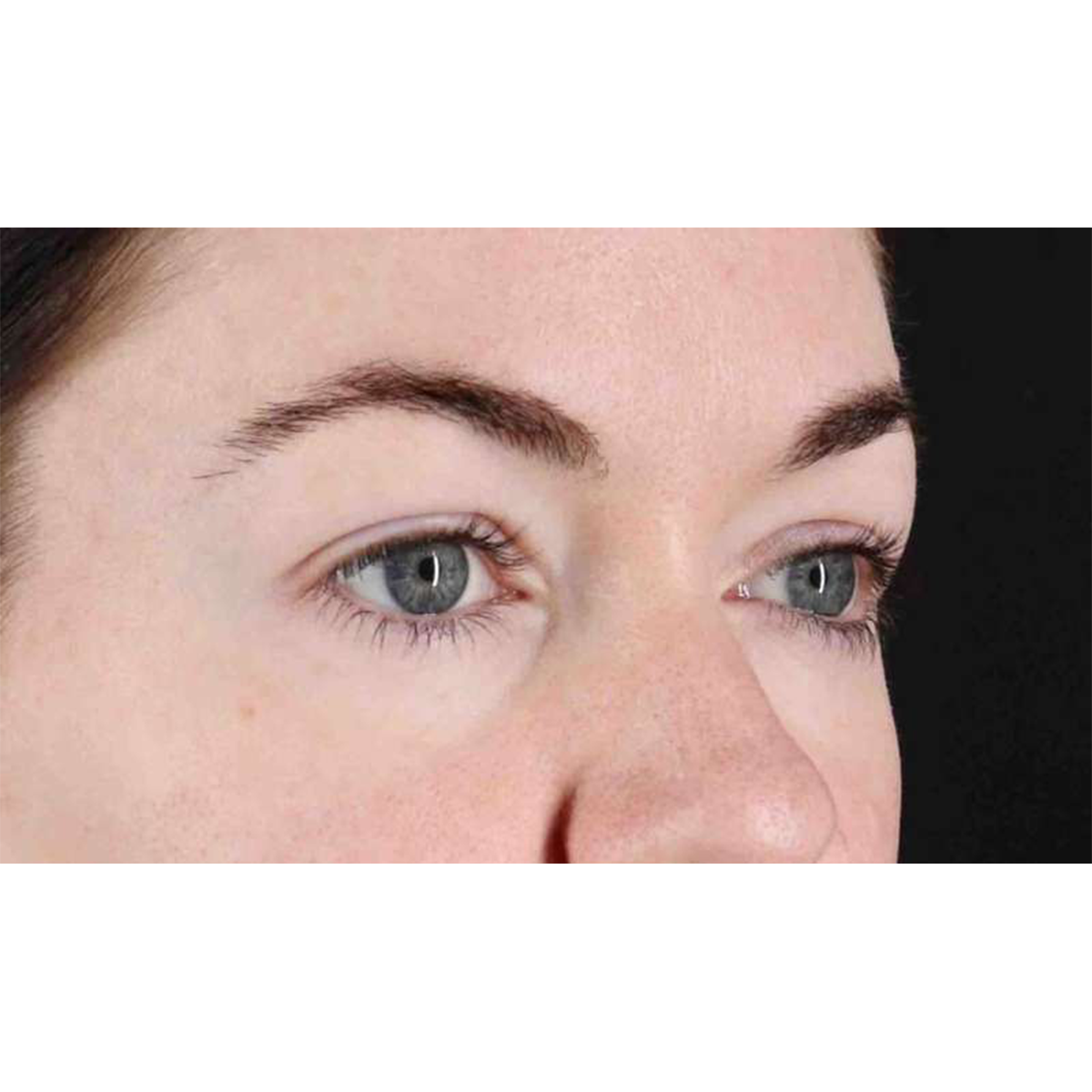 Blepharoplasty (Eyelid Surgery) Before & After Patient #10716
