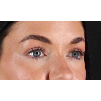 Blepharoplasty (Eyelid Surgery) Before & After Patient #10716