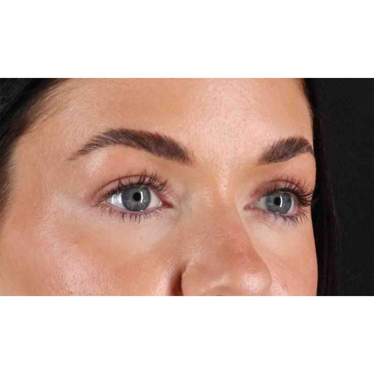 Blepharoplasty (Eyelid Surgery) Before & After Patient #10716