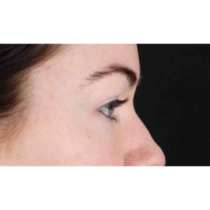 Blepharoplasty (Eyelid Surgery) Before & After Patient #10716