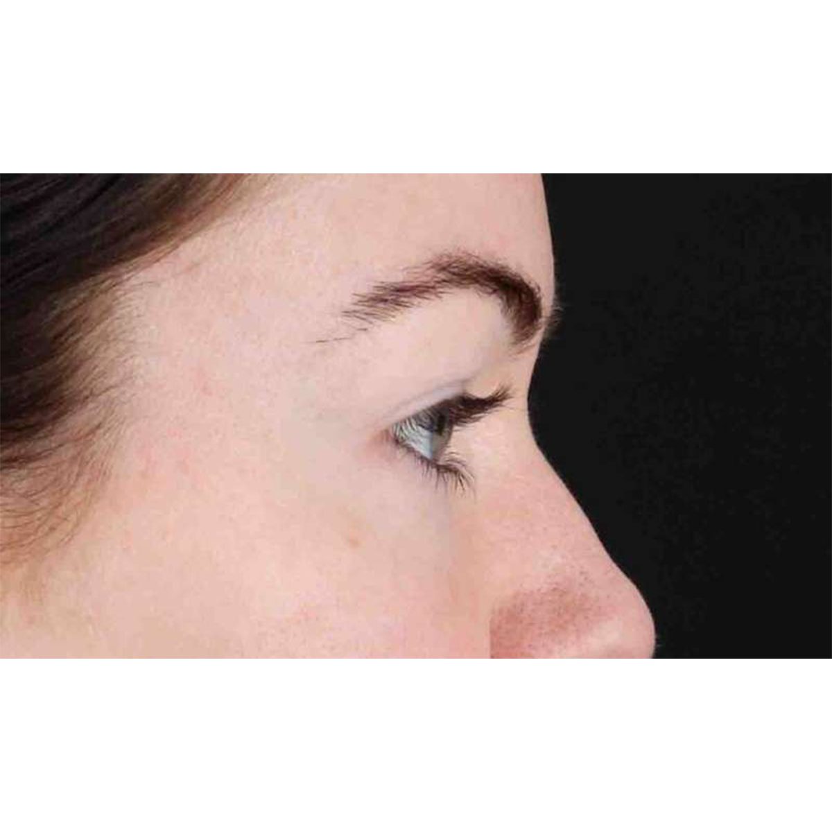 Blepharoplasty (Eyelid Surgery) Before & After Patient #10716