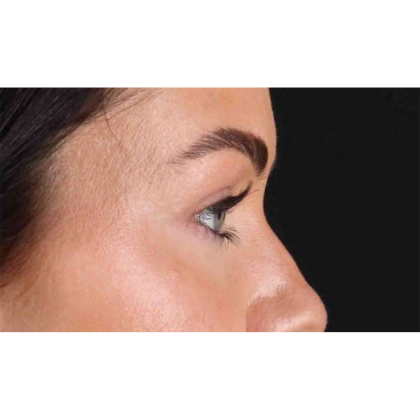 Blepharoplasty (Eyelid Surgery) Before & After Patient #10716