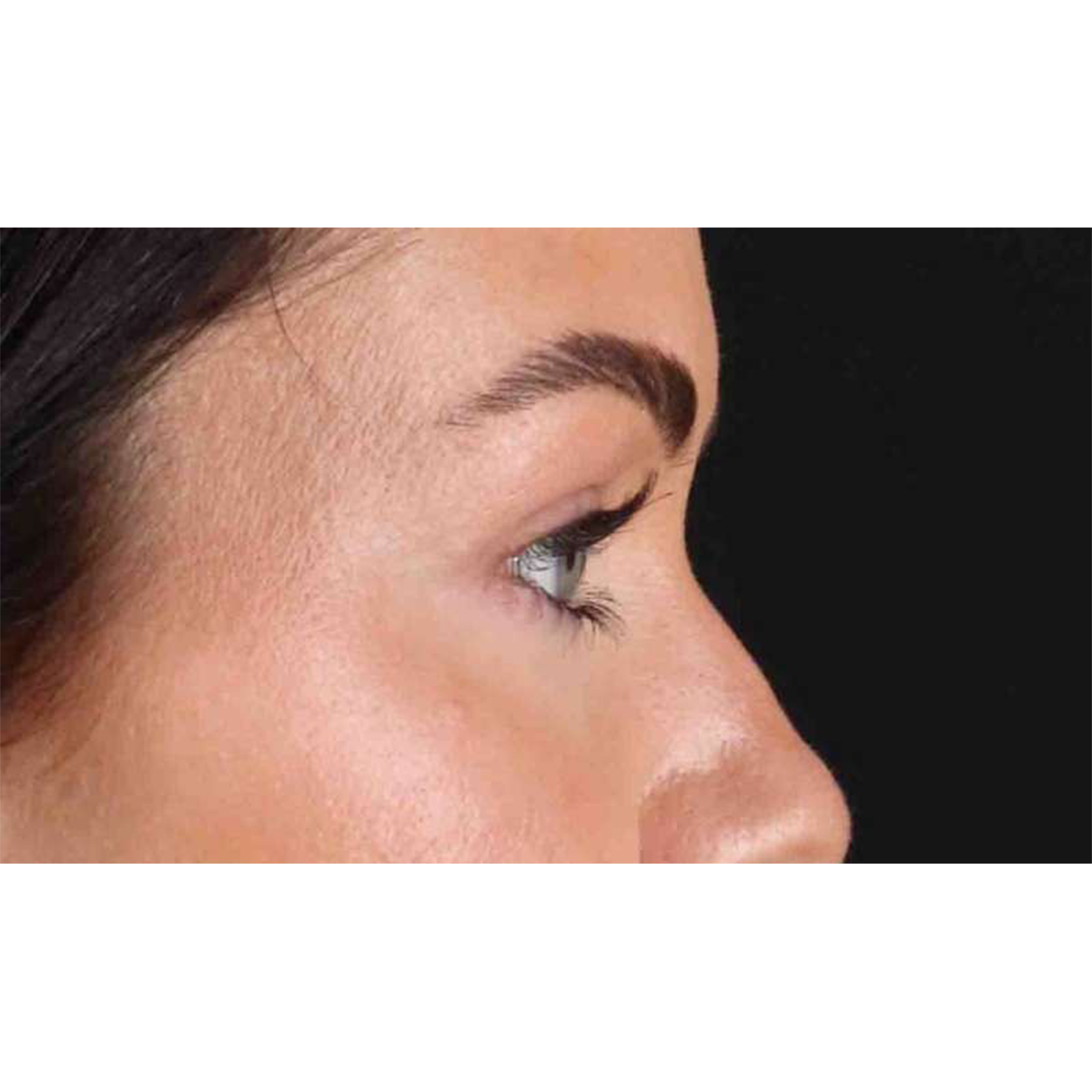 Blepharoplasty (Eyelid Surgery) Before & After Patient #10716
