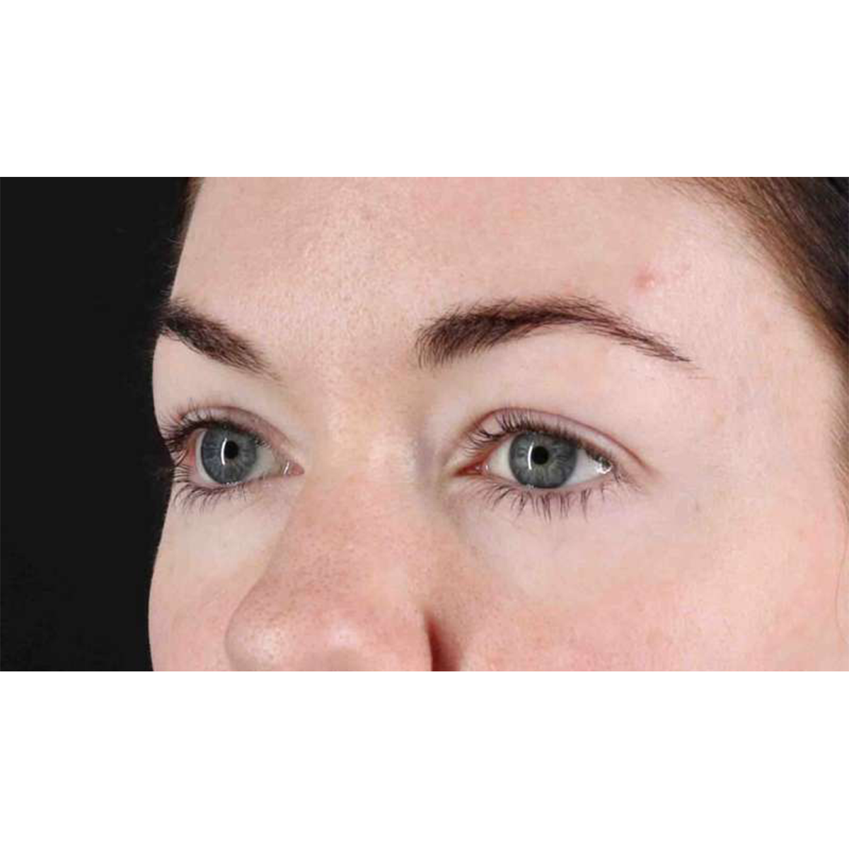Blepharoplasty (Eyelid Surgery) Before & After Patient #10716