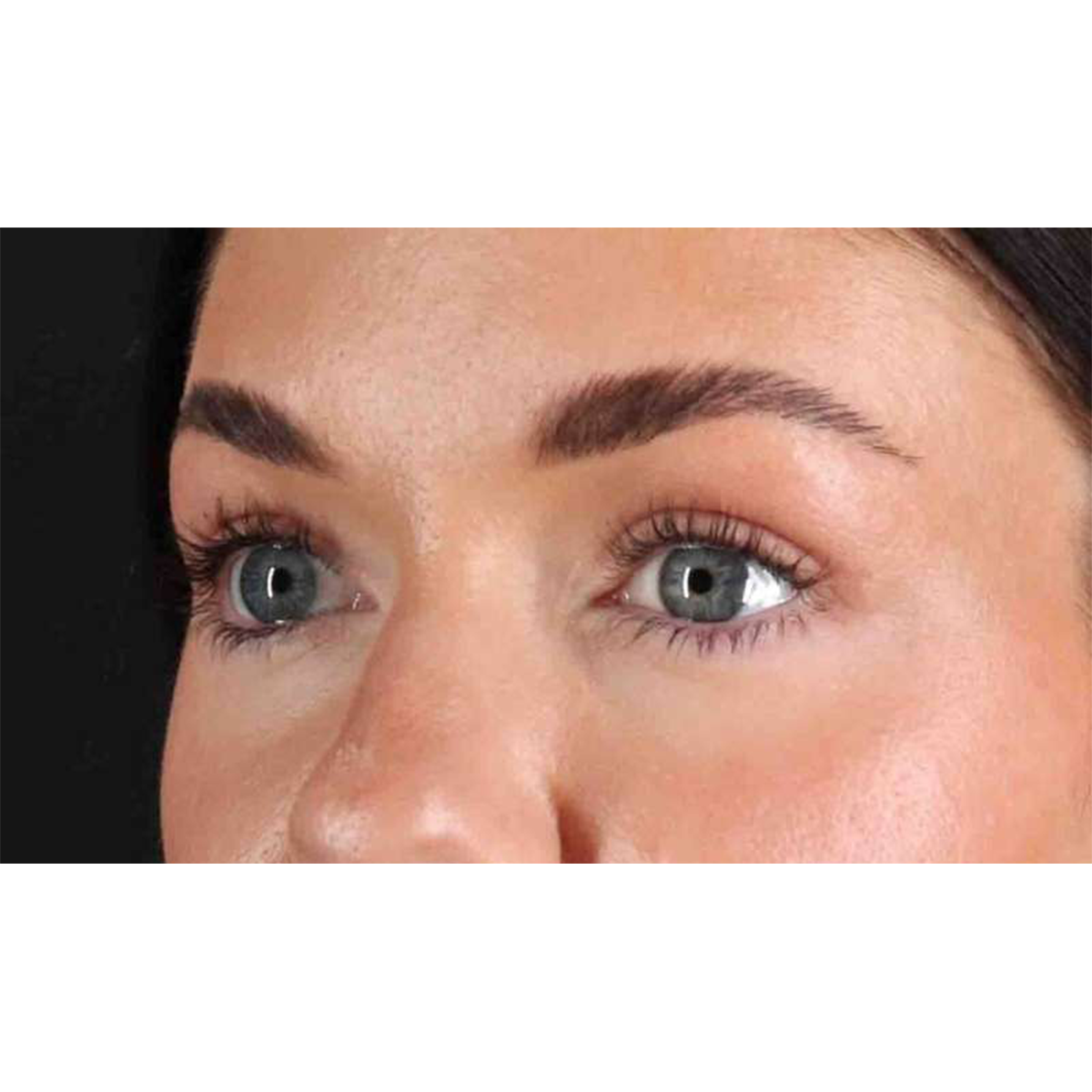 Blepharoplasty (Eyelid Surgery) Before & After Patient #10716