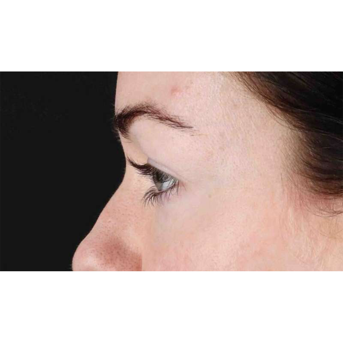 Blepharoplasty (Eyelid Surgery) Before & After Patient #10716