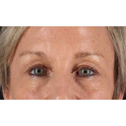 Blepharoplasty (Eyelid Surgery) Before & After Patient #10705
