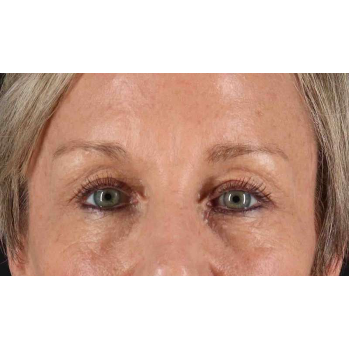 Blepharoplasty (Eyelid Surgery) Before & After Patient #10705