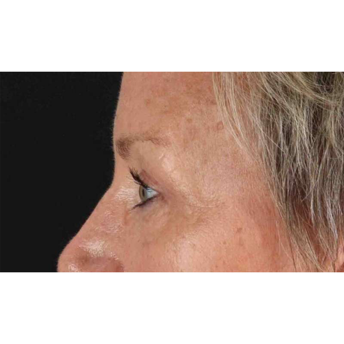 Blepharoplasty (Eyelid Surgery) Before & After Patient #10705