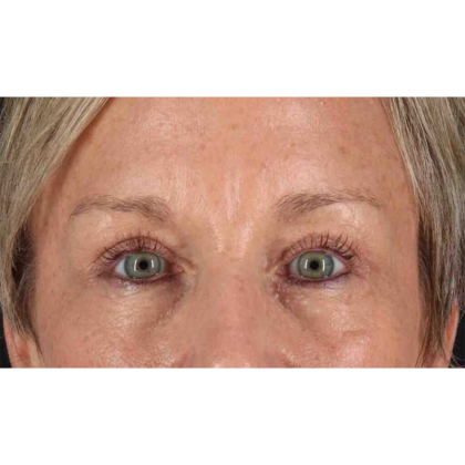 Blepharoplasty (Eyelid Surgery) Before & After Patient #10705