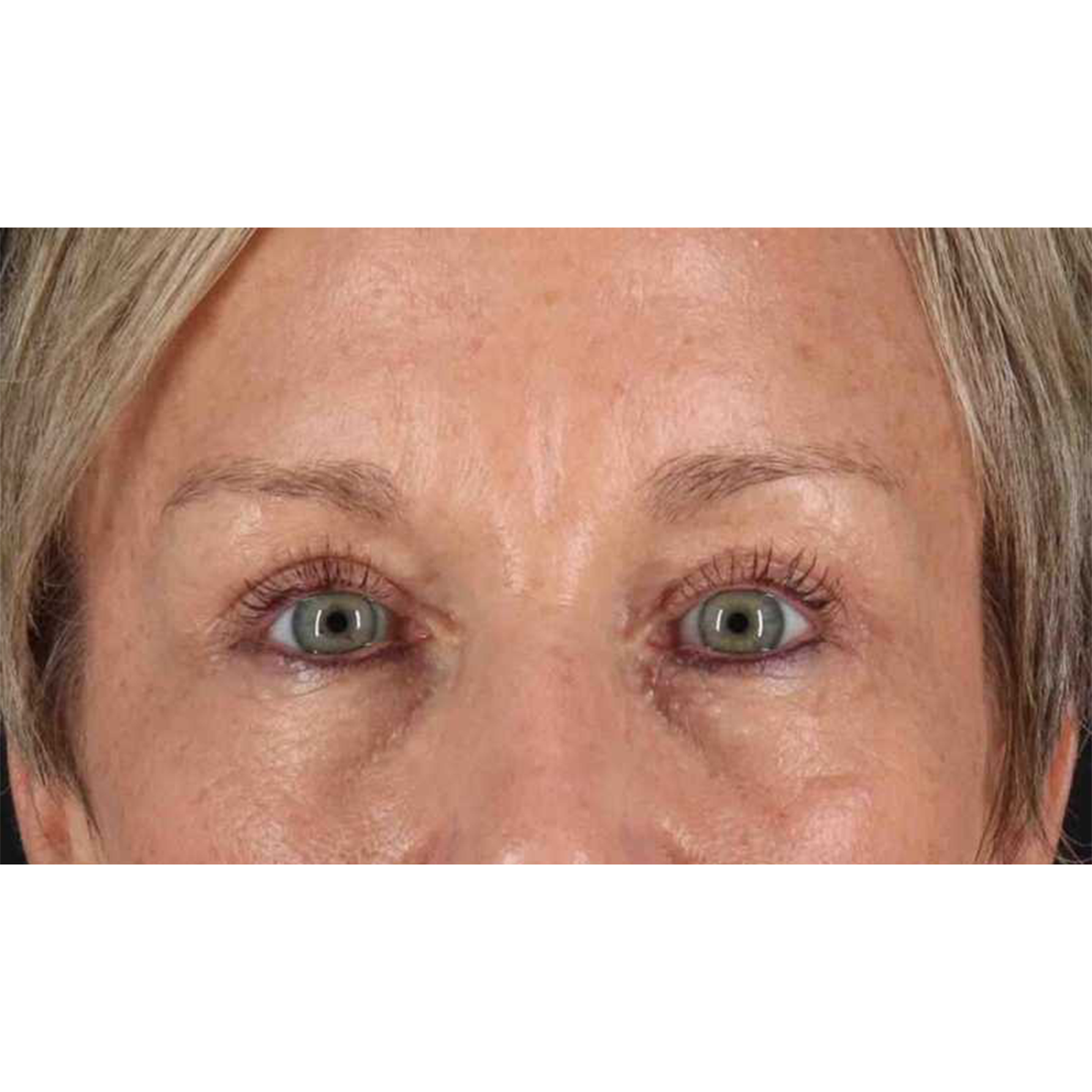 Blepharoplasty (Eyelid Surgery) Before & After Patient #10705