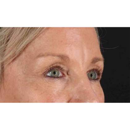 Blepharoplasty (Eyelid Surgery) Before & After Patient #10705