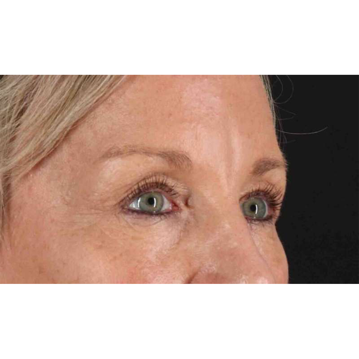 Blepharoplasty (Eyelid Surgery) Before & After Patient #10705