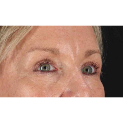 Blepharoplasty (Eyelid Surgery) Before & After Patient #10705