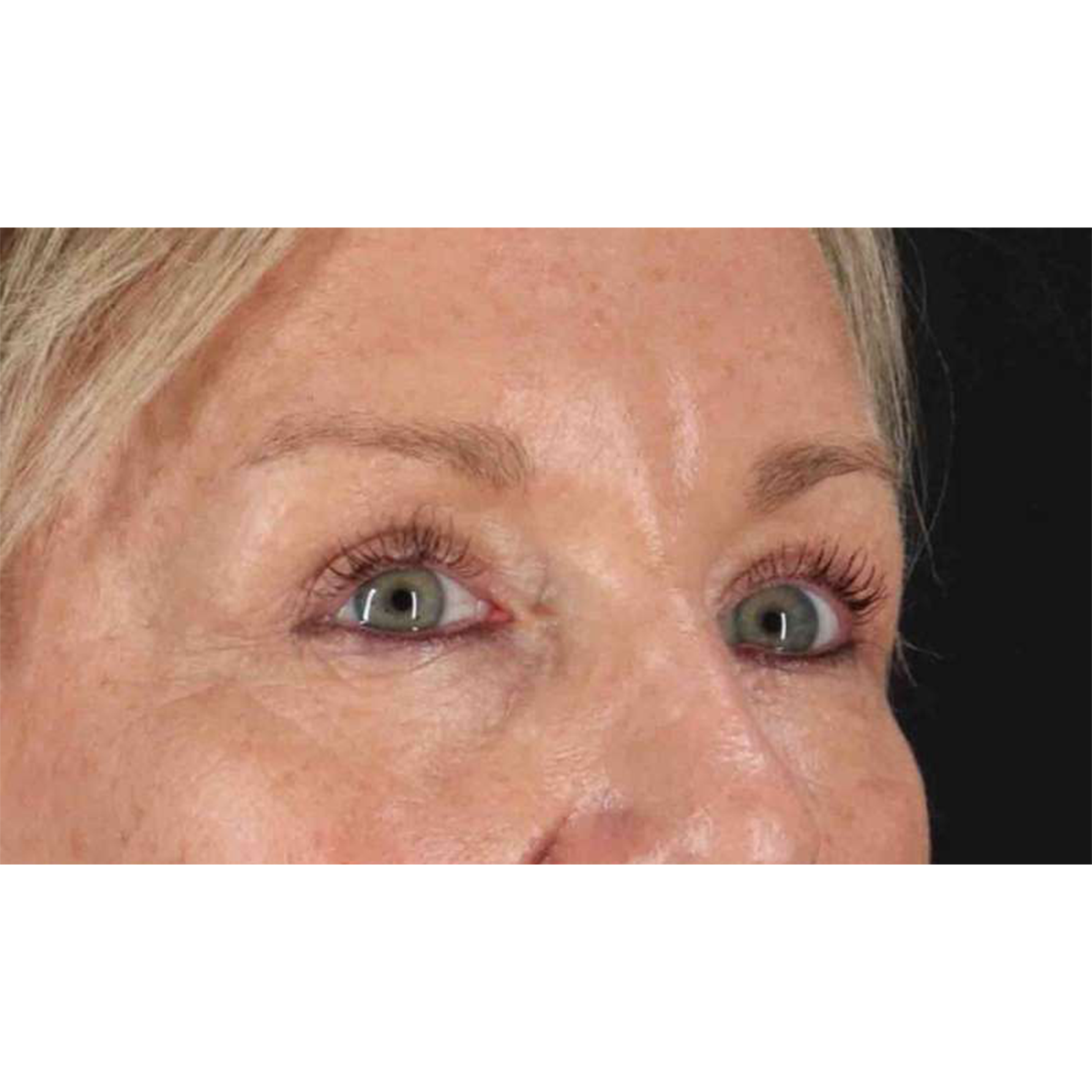 Blepharoplasty (Eyelid Surgery) Before & After Patient #10705