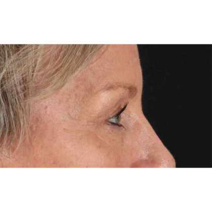 Blepharoplasty (Eyelid Surgery) Before & After Patient #10705