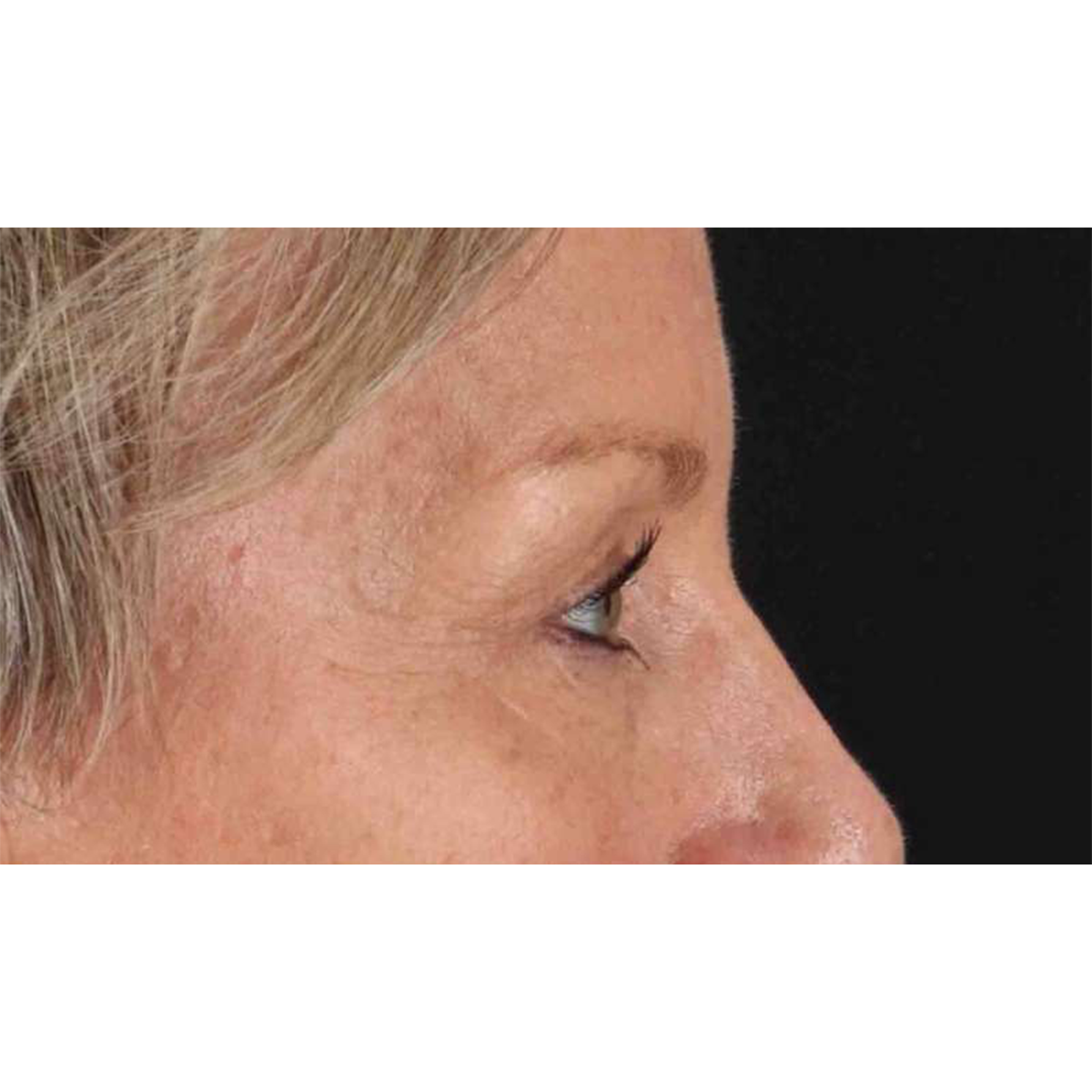 Blepharoplasty (Eyelid Surgery) Before & After Patient #10705
