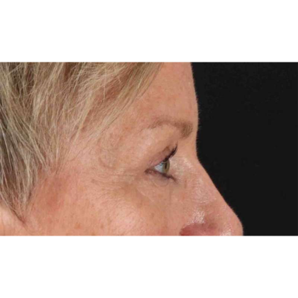Blepharoplasty (Eyelid Surgery) Before & After Patient #10705