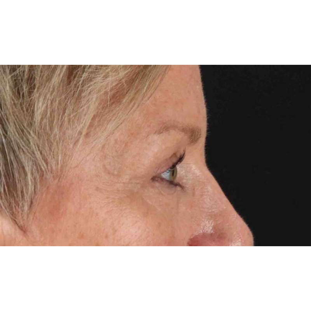 Blepharoplasty (Eyelid Surgery) Before & After Patient #10705