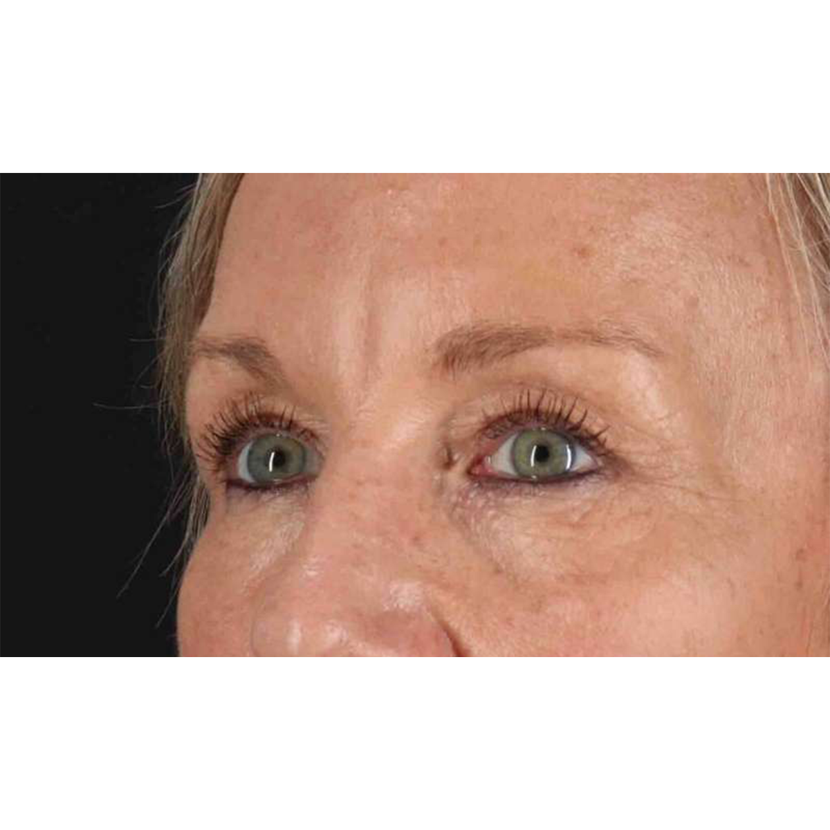 Blepharoplasty (Eyelid Surgery) Before & After Patient #10705