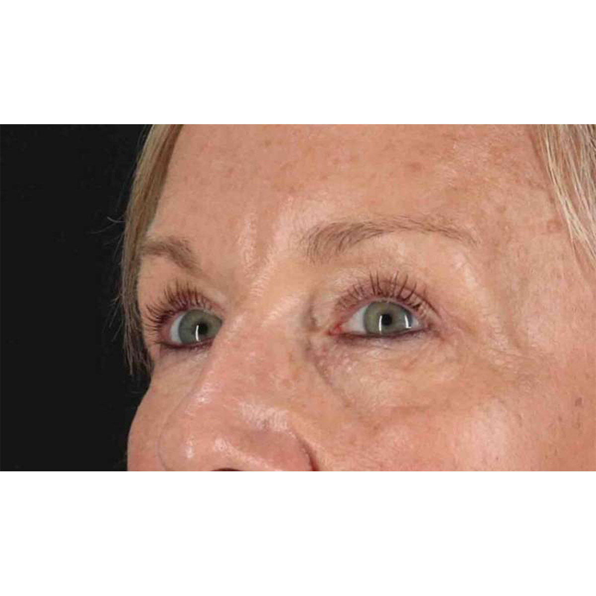 Blepharoplasty (Eyelid Surgery) Before & After Patient #10705