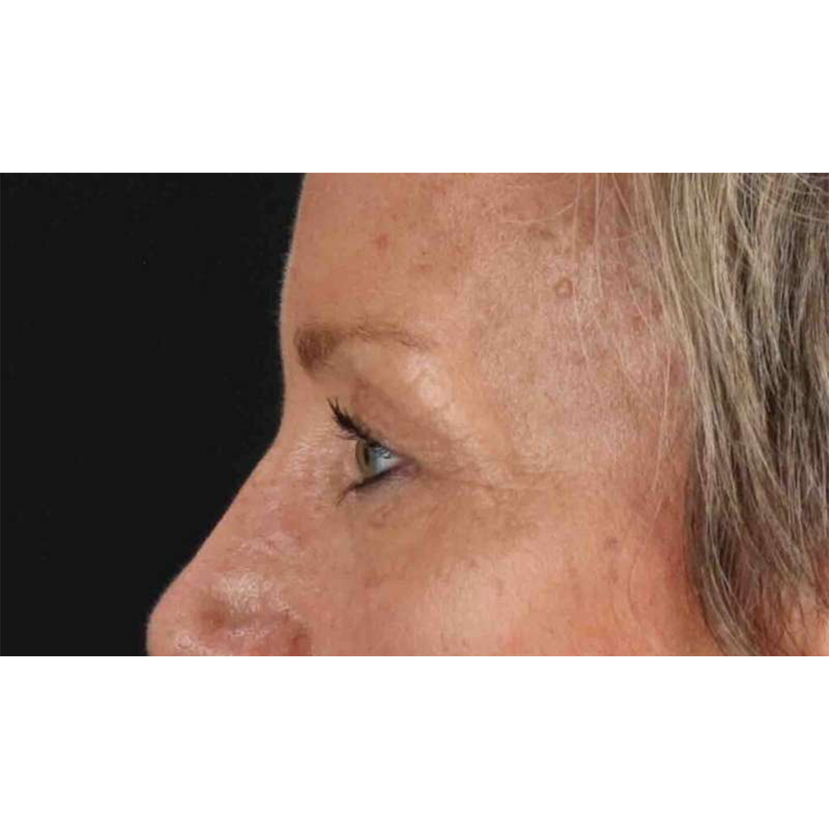Blepharoplasty (Eyelid Surgery) Before & After Patient #10705