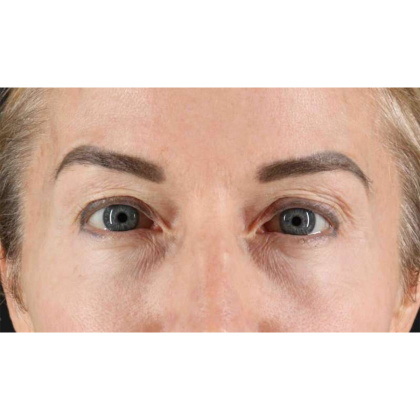 Blepharoplasty (Eyelid Surgery) Before & After Patient #10694